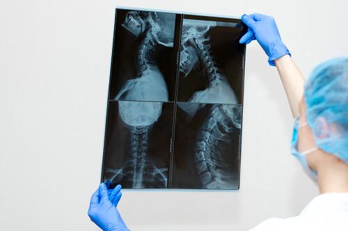 Osteochondrosis spinal disease