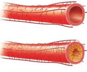 Normally vessel and with bad patence with advanced phase of cervical osteochondrose